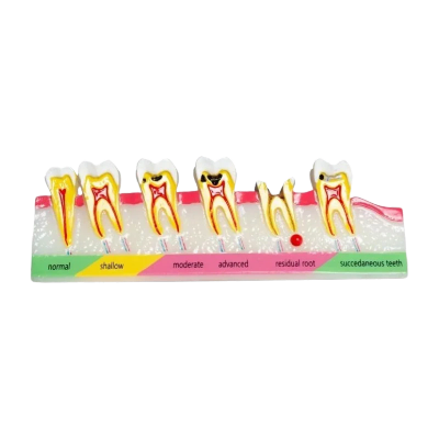 Modelo caries